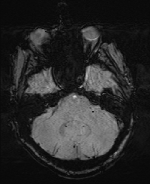 Brain metastases - lung cancer primary (Radiopaedia 75060-86115 Axial SWI 16).jpg