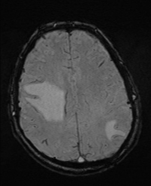 Brain metastases - lung cancer primary (Radiopaedia 75060-86115 Axial SWI 42).jpg