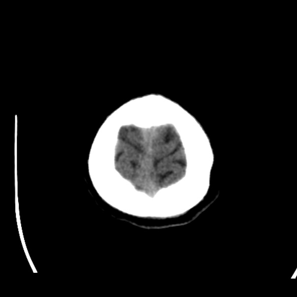 Brain metastases from lung cancer (Radiopaedia 24480-24781 Axial non-contrast 49).jpg