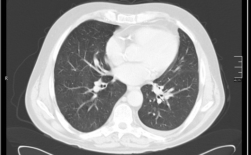 Brain metastases from squamocellular lung cancer (Radiopaedia 56515-63219 Axial lung window 39).jpg
