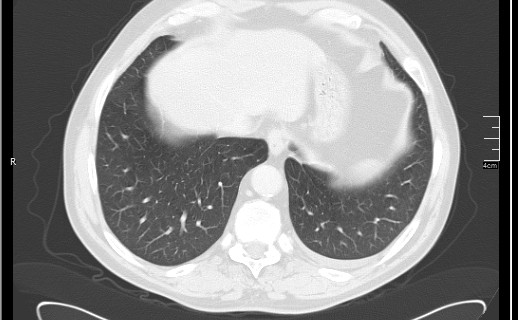 File:Brain metastases from squamocellular lung cancer (Radiopaedia 56515-63219 Axial lung window 52).jpg