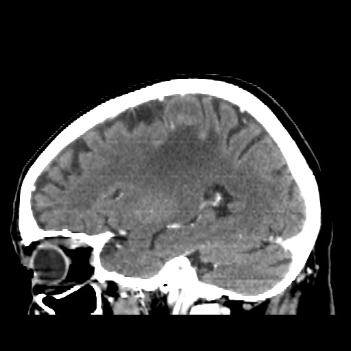 Brain metastasis (Radiopaedia 42617-45760 D 39).jpg
