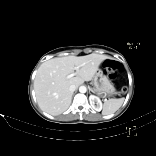 Brain metastasis as initial presentation of non-small cell lung cancer (Radiopaedia 65122-74127 A 46).jpg