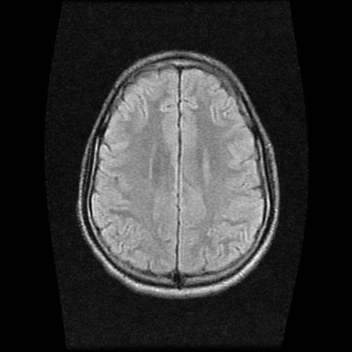 File:Brainstem glioma (Radiopaedia 30923-31624 Axial FLAIR 17).jpg