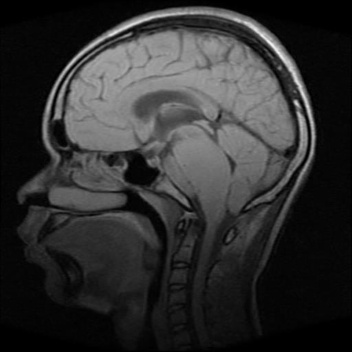 File:Brainstem glioma (Radiopaedia 30923-31624 Sagittal T1 9).jpg