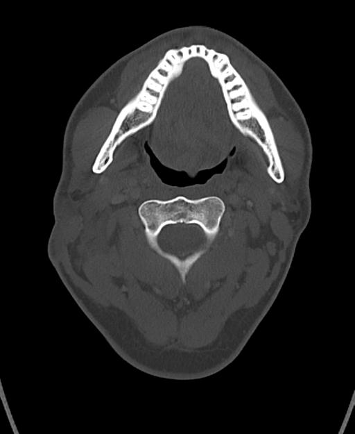 Branchial cleft cyst (Radiopaedia 31167-31875 Axial bone window 24).jpg