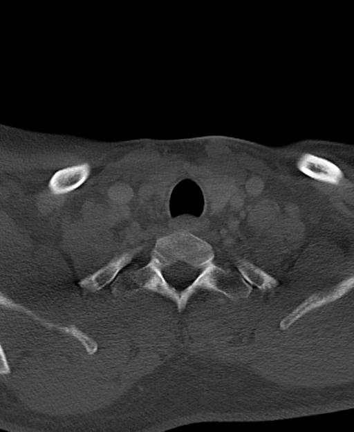 Branchial cleft cyst (Radiopaedia 31167-31875 Axial bone window 64).jpg