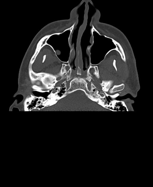 Branchial cleft cyst (Radiopaedia 31167-31875 Axial bone window 7).jpg