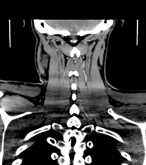 Branchial cleft cyst (Radiopaedia 31167-31875 Coronal C+ delayed 50).jpg