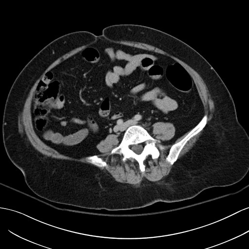 Breast carcinoma with pathological hip fracture (Radiopaedia 60314-67974 B 44).jpg