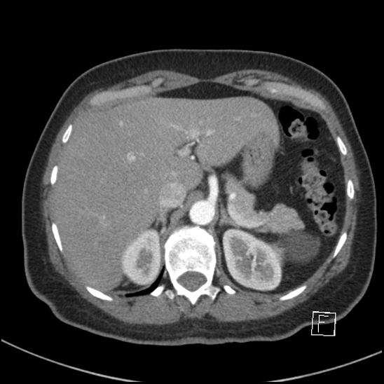 Breast metastases from renal cell cancer (Radiopaedia 79220-92225 A 88).jpg
