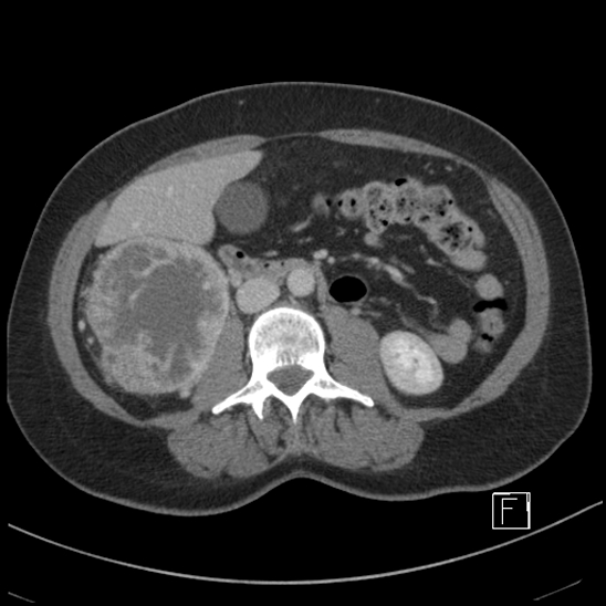 File:Breast metastases from renal cell cancer (Radiopaedia 79220-92225 C 50).jpg