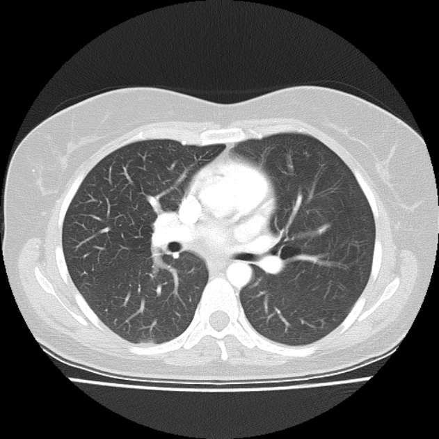 Bronchial atresia (Radiopaedia 22965-22992 Axial lung window 28).jpg