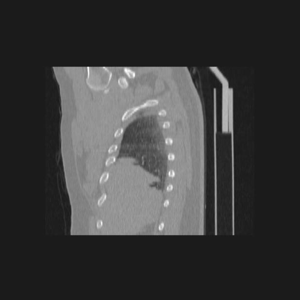 Bronchial atresia (Radiopaedia 60685-68439 Sagittal lung window 8).jpg