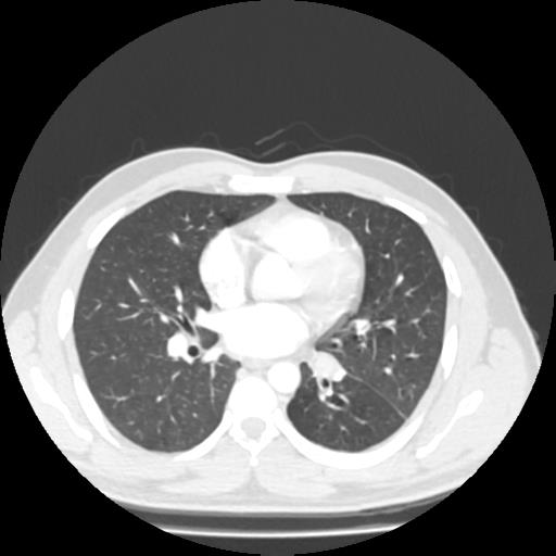 Bronchial carcinoid (Radiopaedia 80013-93291 Axial lung window 63).jpg