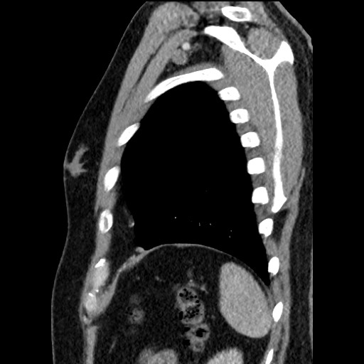 Bronchial carcinoid tumor (Radiopaedia 67377-76764 E 59).jpg