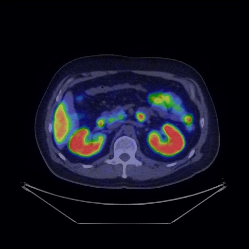 File:Bronchial carcinoid tumor (Radiopaedia 67377-76765 68Ga-DOTATATE PET-CT 47).jpg