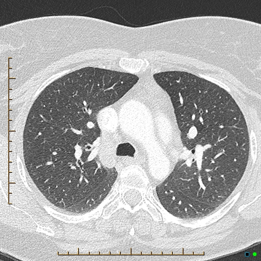 Bronchial diverticula (Radiopaedia 79512-92676 Axial lung window 63).jpg