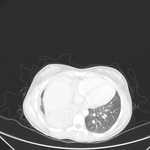 Bronchial mucoepidermoid carcinoma (Radiopaedia 57023-63895 Axial lung window 78).jpg