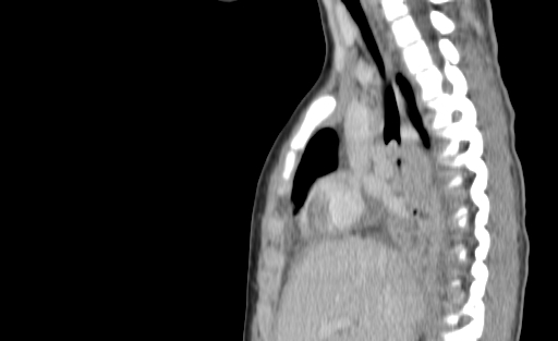 Bronchial mucoepidermoid carcinoma (Radiopaedia 57023-63895 Sagittal 95).jpg