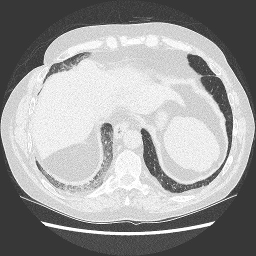 File:Bronchial stenosis - lung transplant (Radiopaedia 73133-83848 C 11).jpg