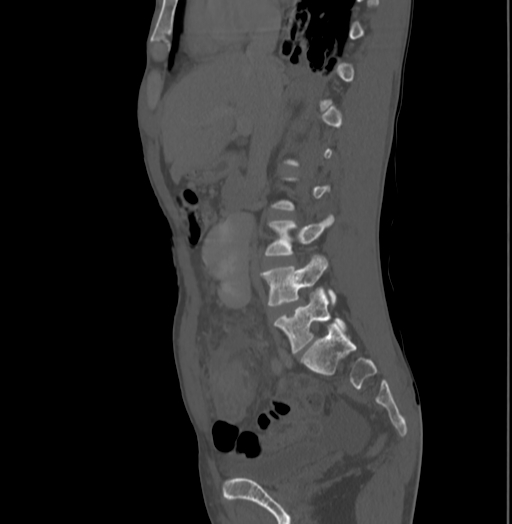 Bronchiectasis in Crohn disease (Radiopaedia 60311-67977 Sagittal bone window 95).jpg