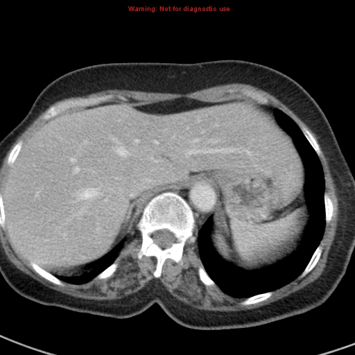File:Bronchoalveolar carcinoma (BAC) (Radiopaedia 13436-13392 B 48).jpg