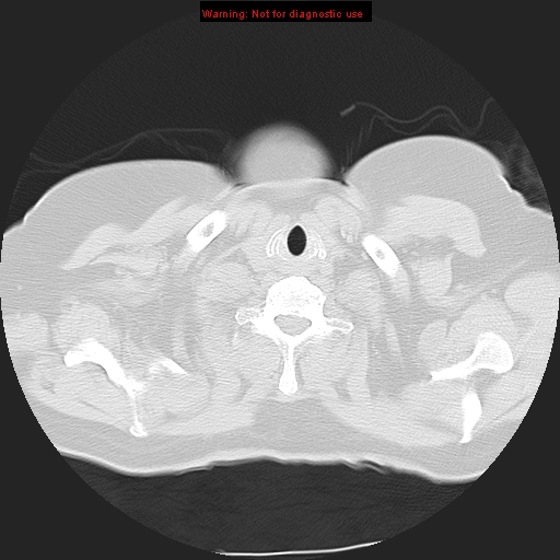 File:Bronchoalveolar carcinoma (Radiopaedia 13224-13233 Axial lung window 2).jpg