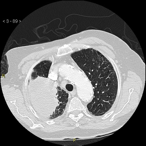 Bronchogenic carcinoma as an incidental finding (Radiopaedia 16453-16130 Axial lung window 89).jpg