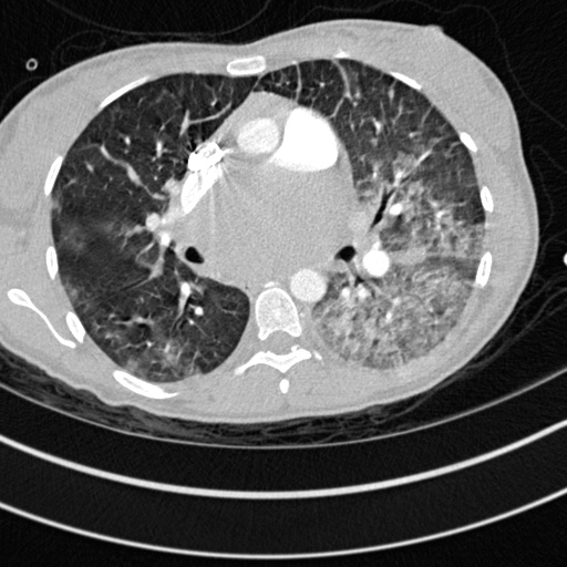 Bronchogenic cyst (Radiopaedia 77801-90071 Axial lung window 31).jpg