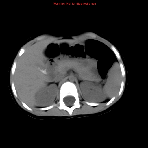 File:Bronchogenic cyst (Radiopaedia 9372-10063 Axial non-contrast 19).jpg