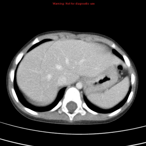 File:Bronchogenic cyst (Radiopaedia 9372-10063 C 23).jpg