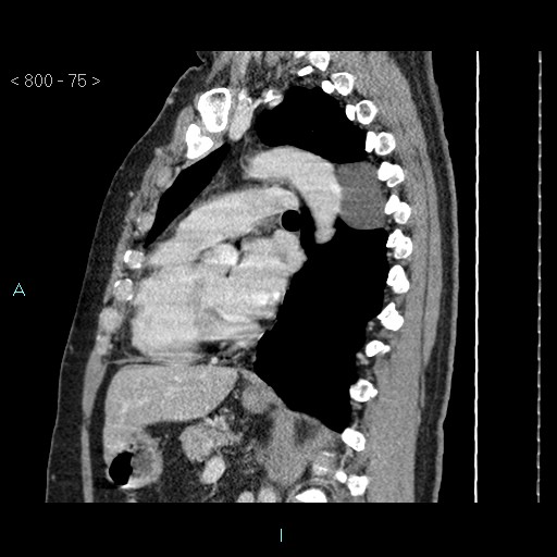 File:Bronchogenic cyst - posterior mediastinal (Radiopaedia 43885-47364 B 50).jpg