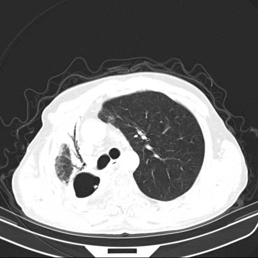 Bronchopleural fistula - postoperative complication (Radiopaedia 21020-20947 Axial lung window 19).jpg