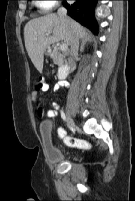 Brown tumors compressing the spinal cord (Radiopaedia 68442-77988 F 24).jpg