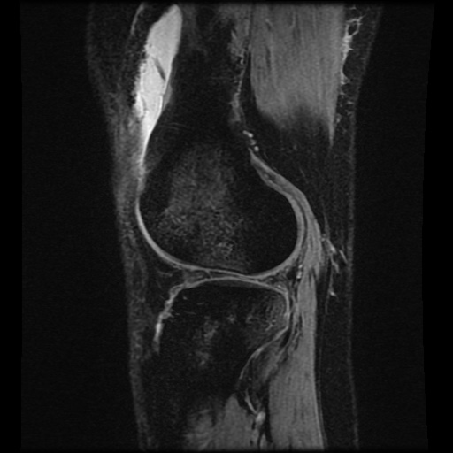 Bucket handle meniscus tear (Radiopaedia 56916-63751 H 18).jpg