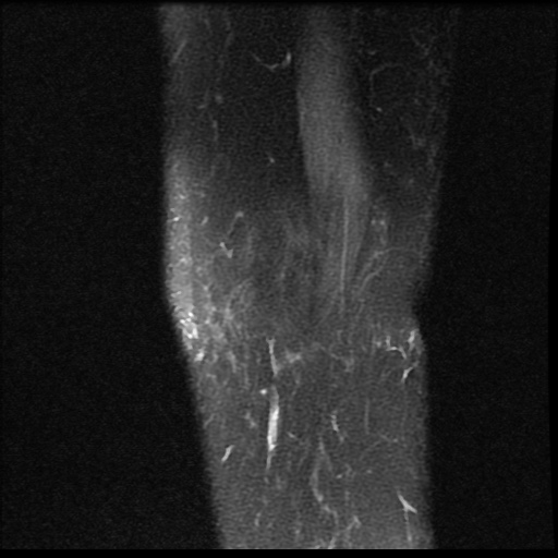 File:Bucket handle meniscus tear (Radiopaedia 56916-63751 Sagittal PD fat sat 19).jpg