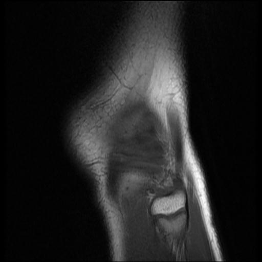 File:Bucket handle tear - lateral meniscus (Radiopaedia 72124-82634 Sagittal T1 1).jpg