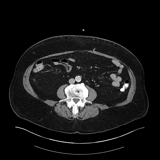 Buried bumper syndrome - gastrostomy tube (Radiopaedia 63843-72575 A 54).jpg