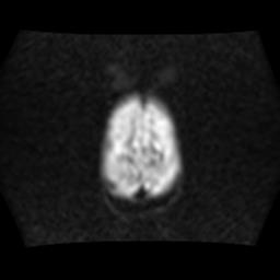 File:Burkitt lymphoma of the orbit- pre and post chemotherapy (Radiopaedia 31214-31930 Axial DWI 16).jpg