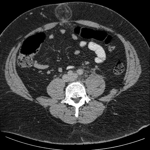 Burned-out testicular seminoma - retroperitoneal nodal metastases (Radiopaedia 62872-71245 A 46).jpg