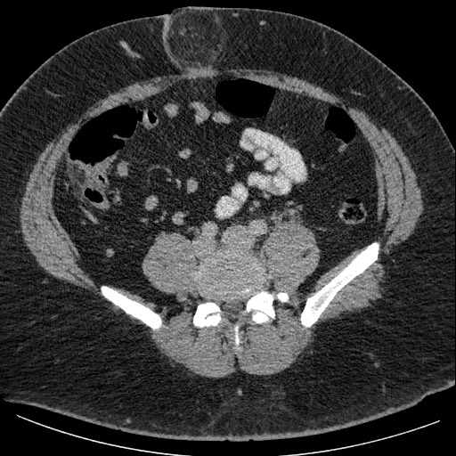 Burned-out testicular seminoma - retroperitoneal nodal metastases (Radiopaedia 62872-71245 A 49).jpg
