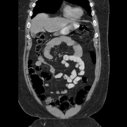 Burned-out testicular seminoma - retroperitoneal nodal metastases (Radiopaedia 62872-71245 B 19).jpg