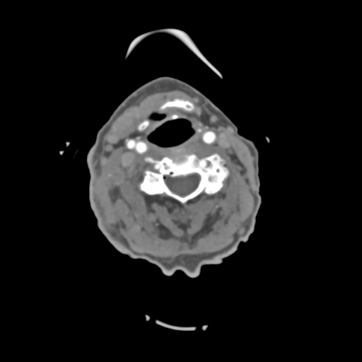 File:C2 fracture with vertebral artery dissection (Radiopaedia 37378-39200 A 135).png