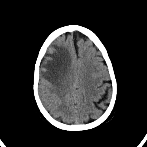 File:CNS Lymphoma (Radiopaedia 44198-47794 Axial non-contrast 27).png