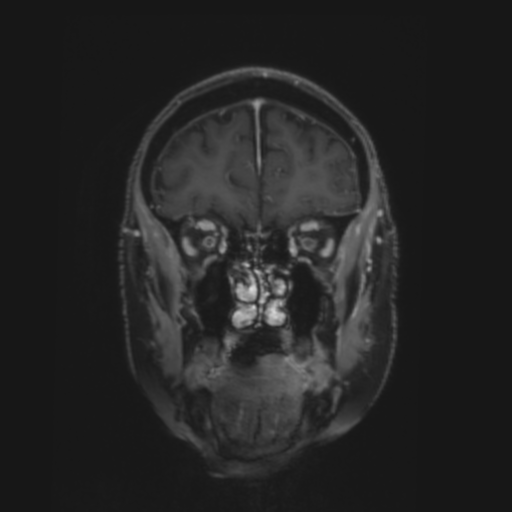 CNS lymphoma with steroid response (Radiopaedia 37980-39921 Coronal T1 C+ 6).png