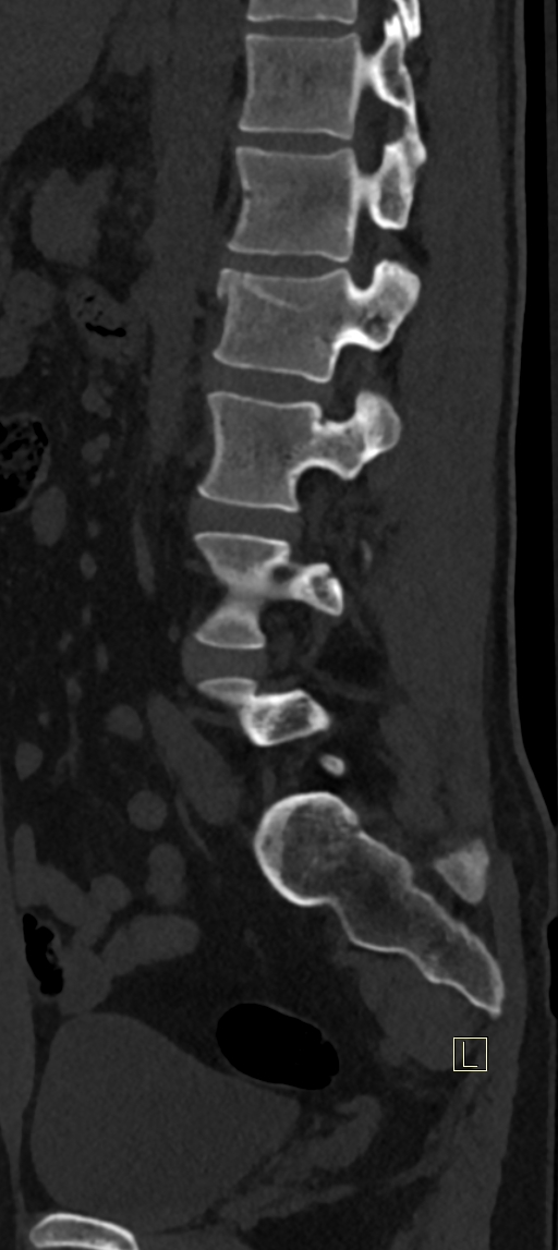 Calcaneal fractures with associated L2 burst fracture (Radiopaedia 71671-82493 Sagittal bone window 23).jpg