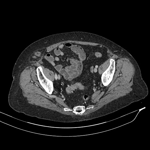 Calcified adrenal glands and Spigelian hernia (Radiopaedia 49741-54988 A 200).jpg