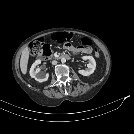 Calcified adrenal glands and Spigelian hernia (Radiopaedia 49741-54988 A 93).jpg