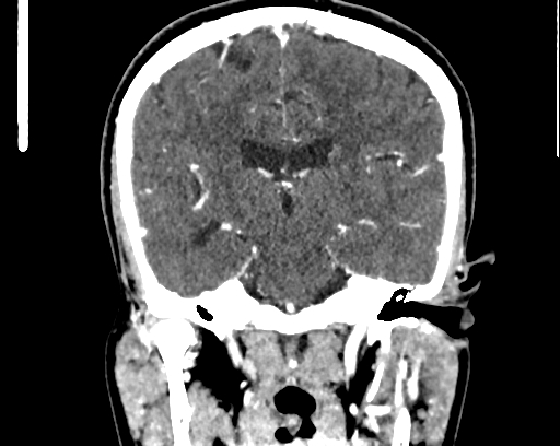 File:Calcified cerebral hydatid cyst (Radiopaedia 65603-74717 C 40).jpg